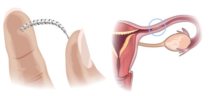 Implant Essure