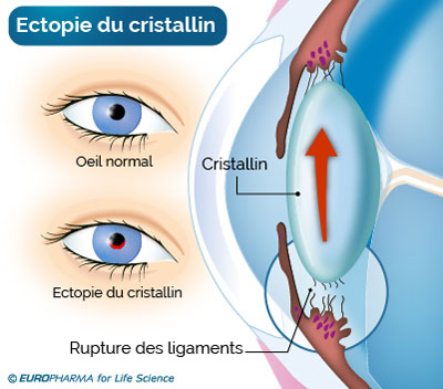 Syndrome De Marfan Definition Symptomes Diagnostic Et Traitements