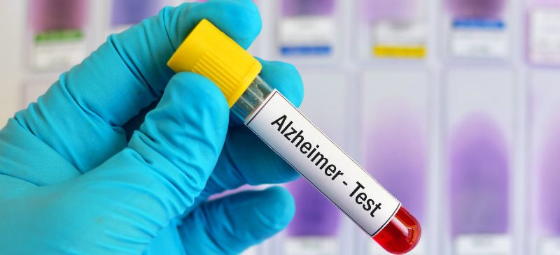 inflammation-Alzheimer