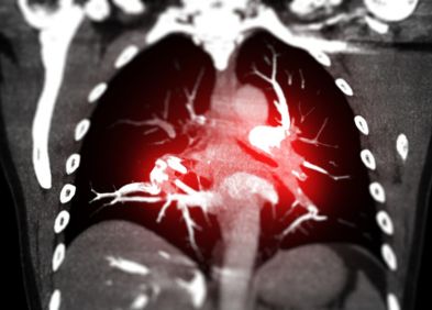 miniature hypertension artérielle