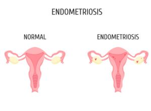 endométriose